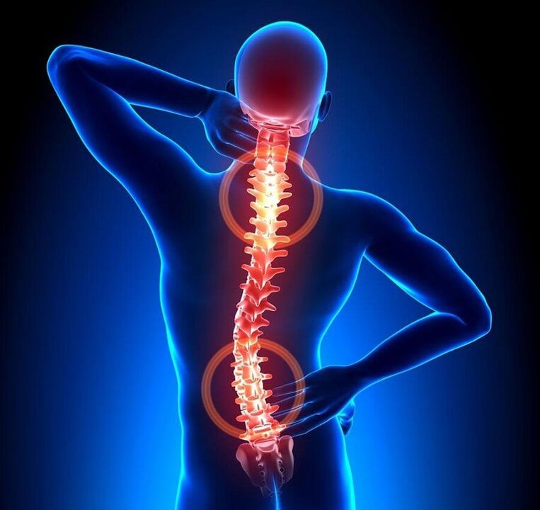 osteochondróza chrbtice ako príčina bolesti chrbta