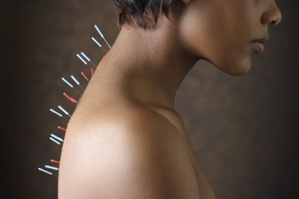 akupunktúra na bolesti chrbta
