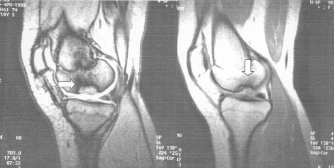 x-ray osteochondrosis dissecans v kolennom kĺbe