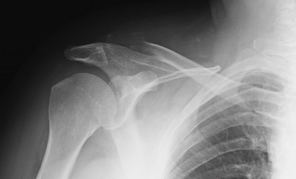 artróza ramena röntgen