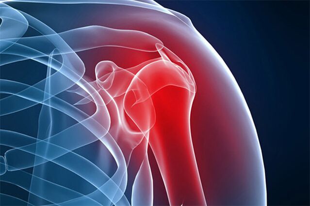 bolesť ramena v dôsledku osteoartrózy