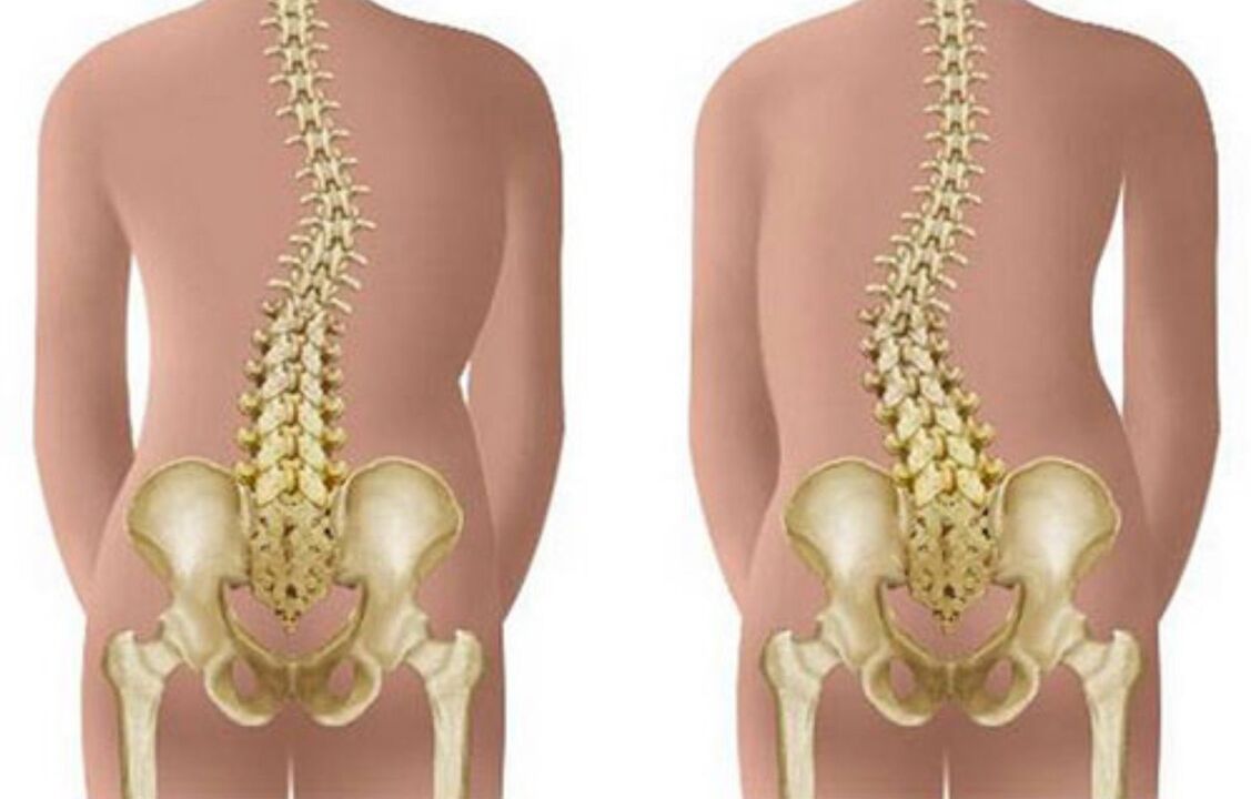 skolióza ako príčina bolesti chrbta v oblasti lopatiek