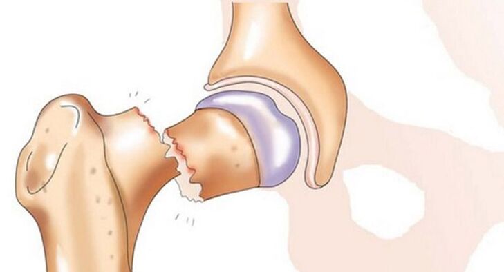 Zlomenina krčka stehennej kosti je sprevádzaná silnou bolesťou v bedrovom kĺbe