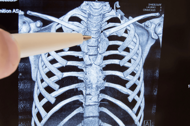 Osteochondróza