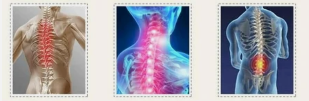 osteochondrosis chrbtice
